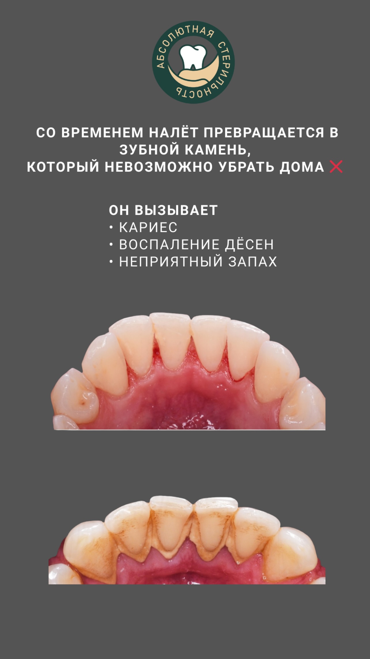 Виниры